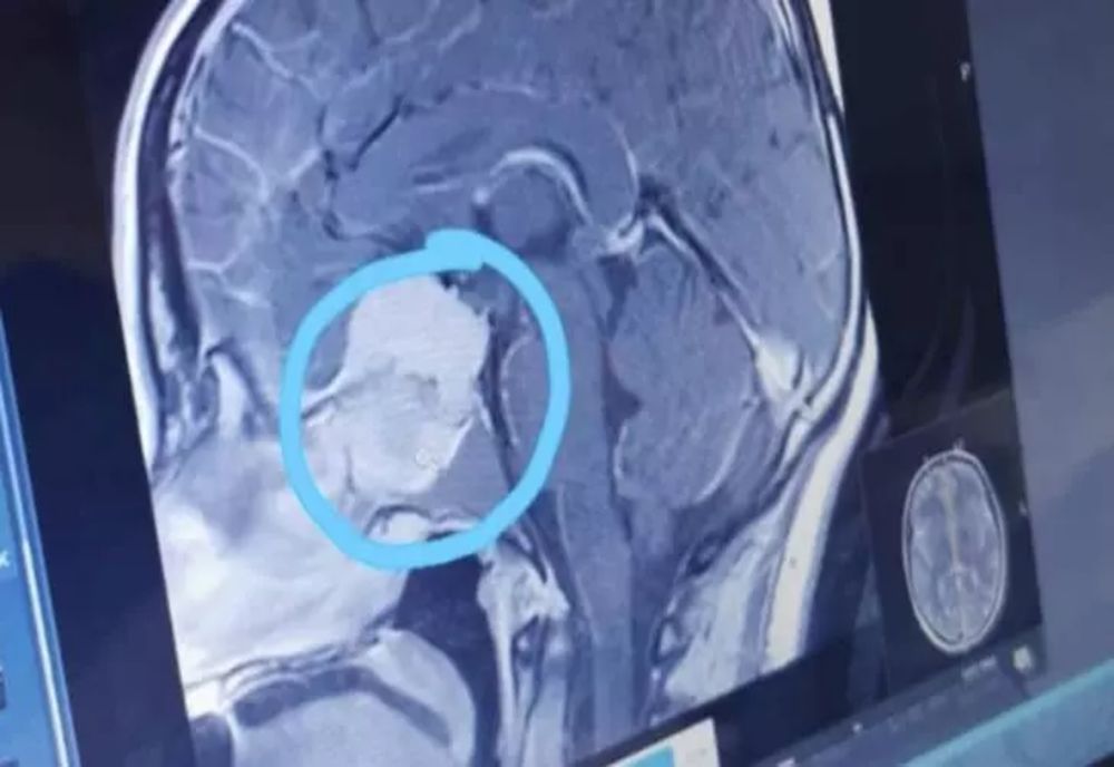 Persoanele cu această grupă de sânge au cel mai mare risc de accident vascular cerebral