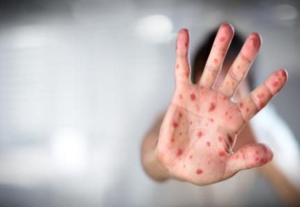 Aproape 800 de cazuri noi de rujeolă, în ultima săptămână, în România. Un copil de 10 ani, nevaccinat, a murit