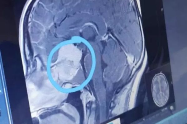 Persoanele cu această grupă de sânge au cel mai mare risc de accident vascular cerebral