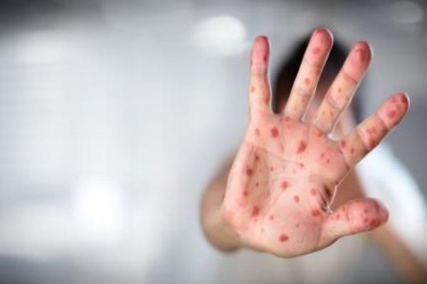 RUJEOLA RĂMÂNE O AMENINȚARE ÎN ROMÂNIA: PESTE 1.000 DE CAZURI RAPORTATE DOAR ÎN LUNA MAI 2025